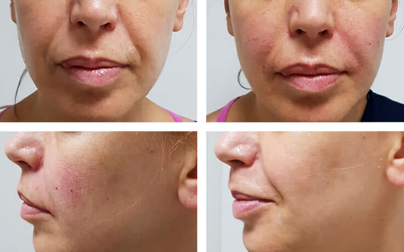 ostia-dental-clinic-anti-aging-filler-treatments-nose-wrinkles