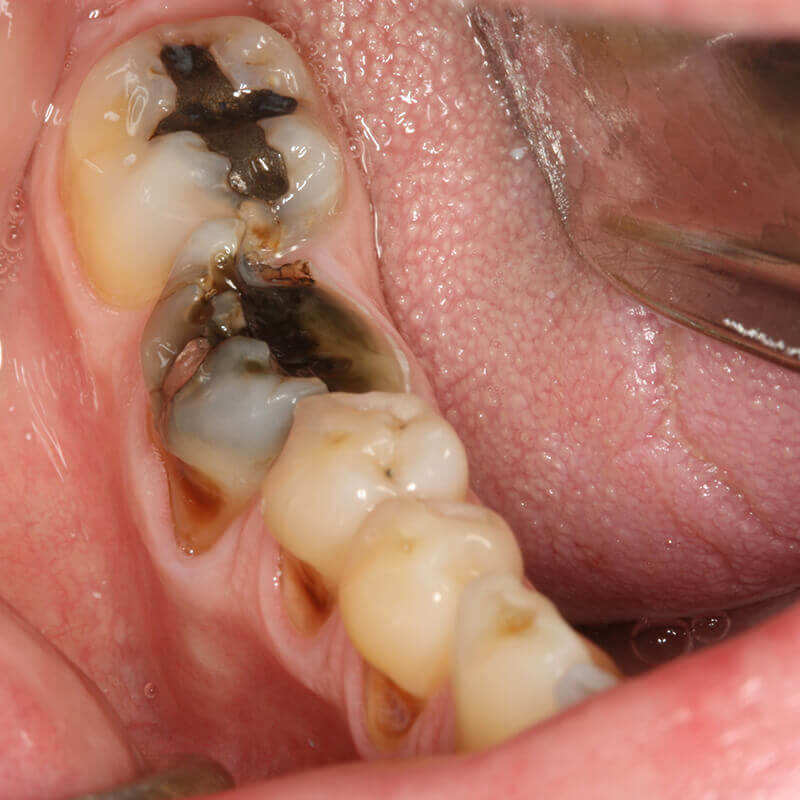 ostia-family-dental-clinic-cavities-fillings-removal