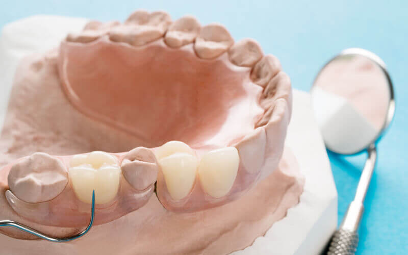 ostia-dental-clinic-dr-carmen-oriolo-denture
