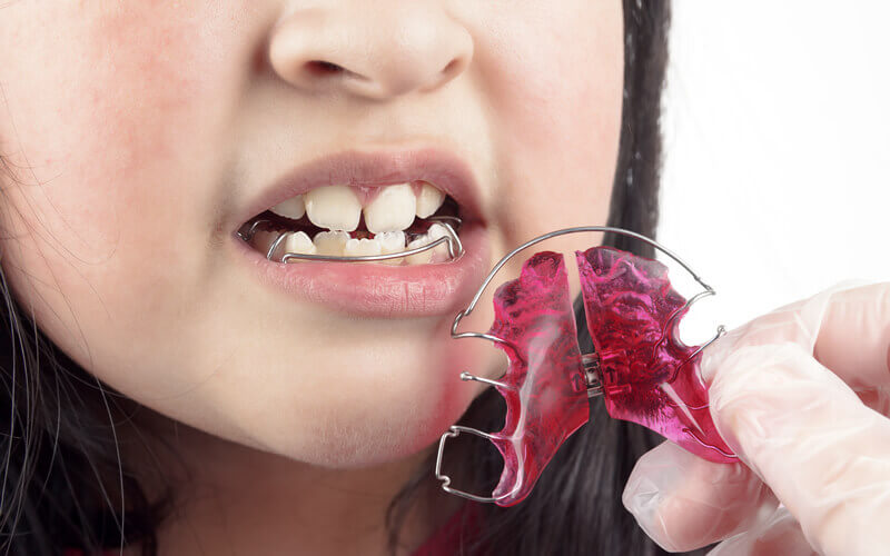 ostia-dental-clinic-dr-carmen-oriolo-kids-orthodontics
