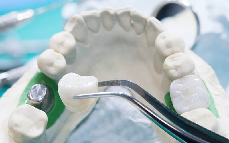 ostia-dental-clinic-dr-carmen-oriolo-metal-free-crowns